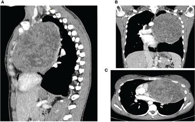 Extraskeletal Ewing’s sarcoma of the mediastinum: Case report